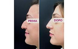 Si può rimodellare il naso senza bisturi? 
La parola all'esperta